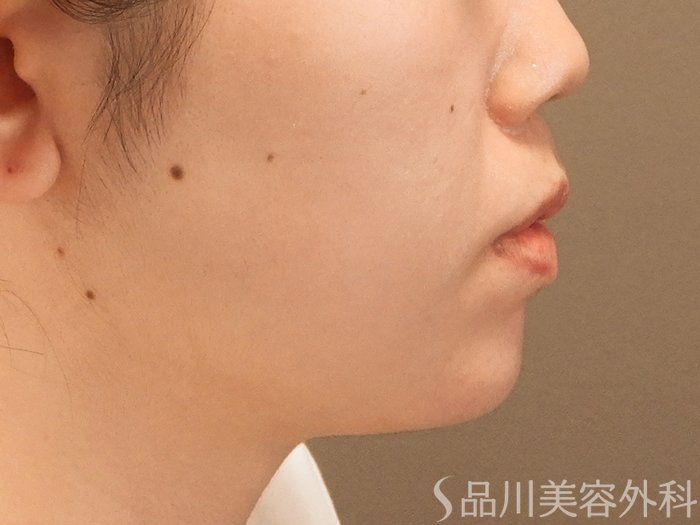 症例NO.70972のAFTER写真