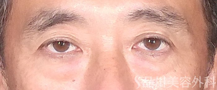 症例NO.65699のBEFORE写真