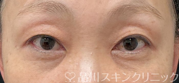 症例NO.74652のBEFORE写真