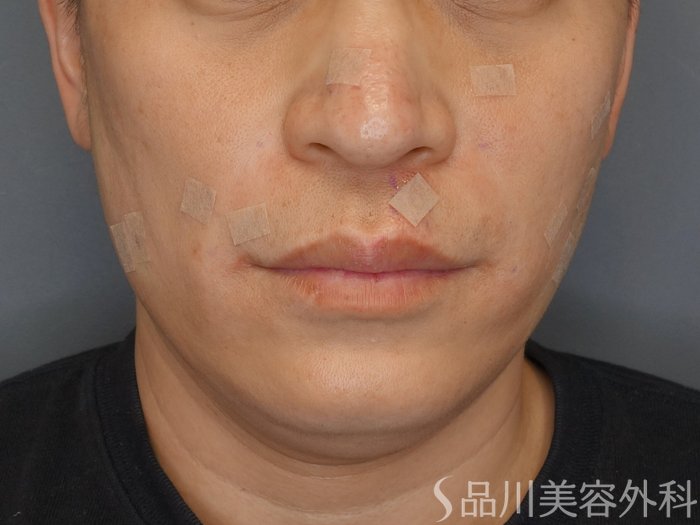 症例NO.73048のAFTER写真