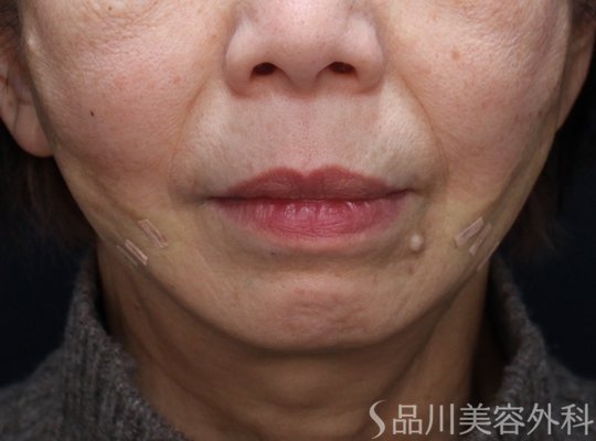 症例NO.73294のAFTER写真