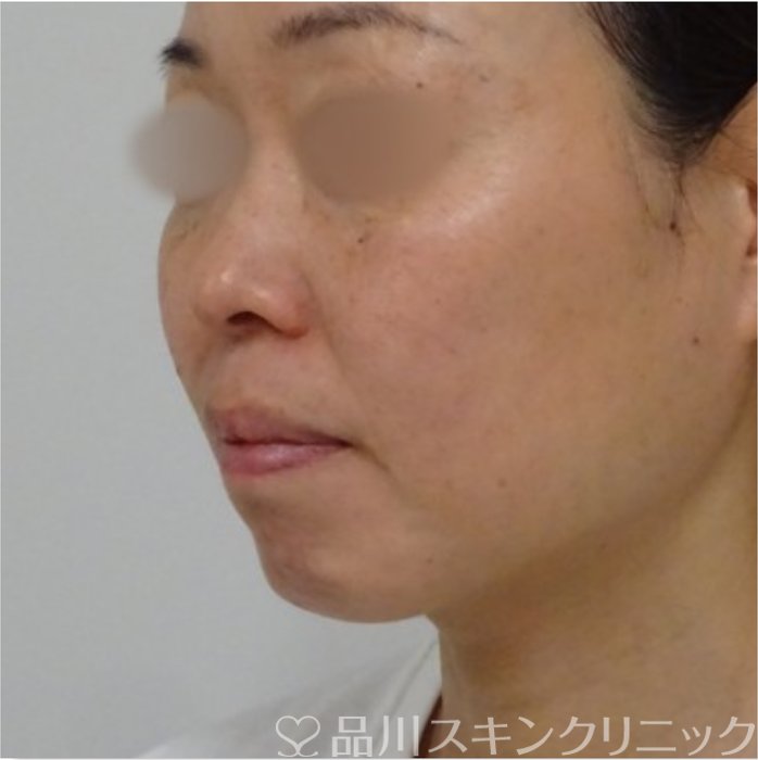 症例NO.70438のAFTER写真