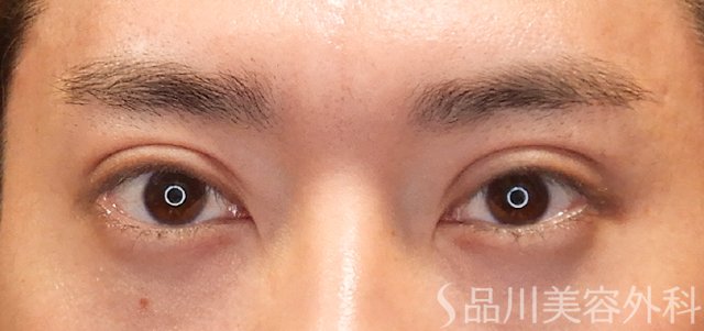 症例NO.72151のAFTER写真