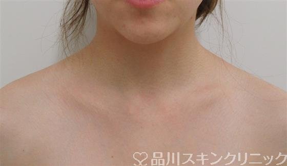 症例NO.41628のBEFORE写真
