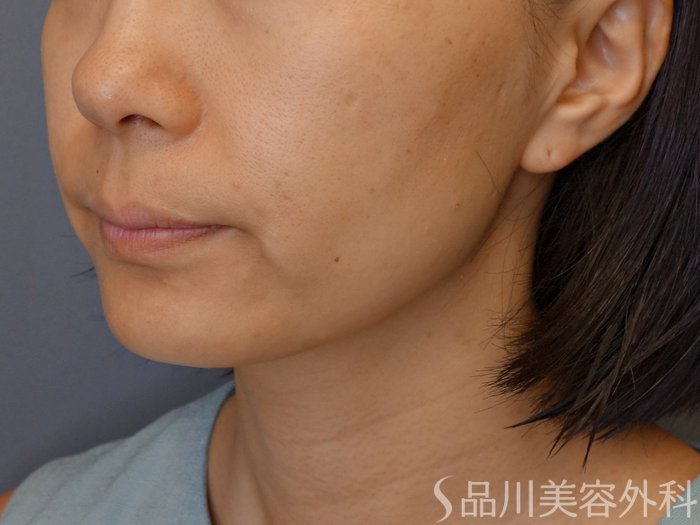 症例NO.71462のBEFORE写真
