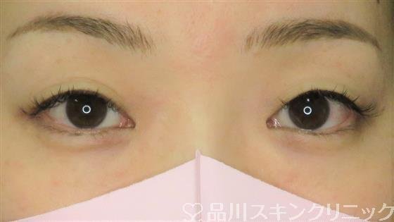 症例NO.61513のBEFORE写真