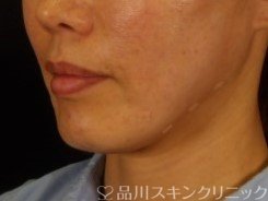 症例NO.72355のAFTER写真