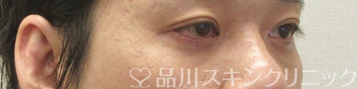 症例NO.71038のAFTER写真