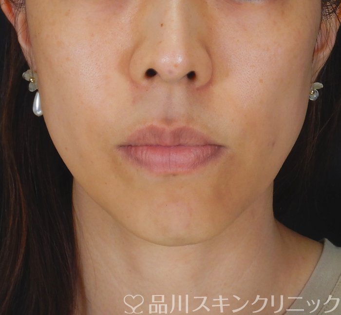 症例NO.67367のBEFORE写真