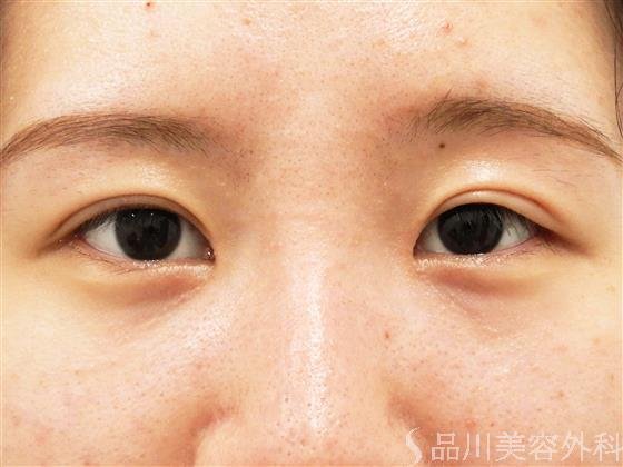 症例NO.56456のAFTER写真