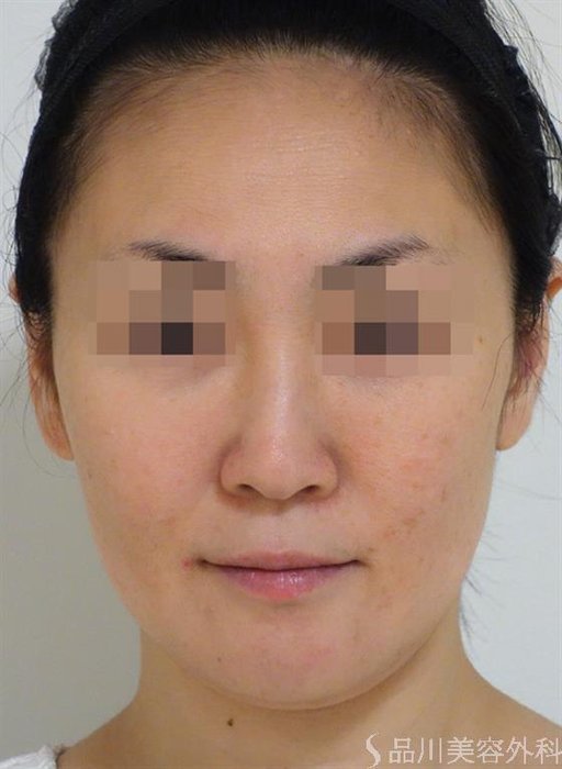 症例NO.45725のBEFORE写真