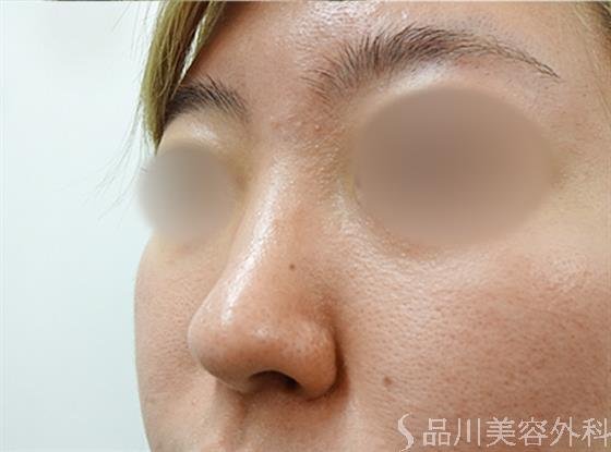 症例NO.33581のBEFORE写真