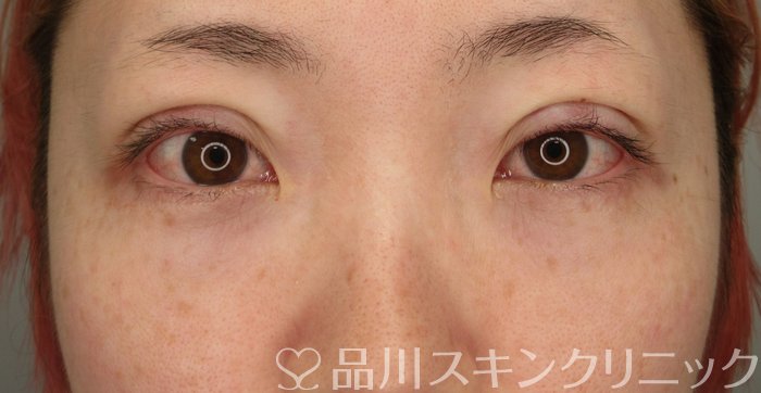 症例NO.73710のAFTER写真