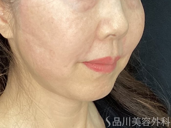 症例NO.72545のAFTER写真