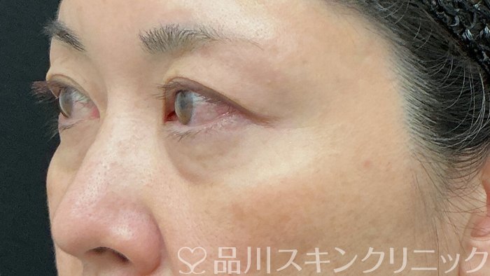 症例NO.74278のBEFORE写真