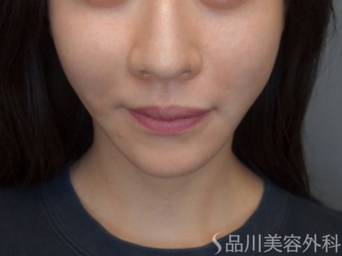 症例NO.74408のAFTER写真