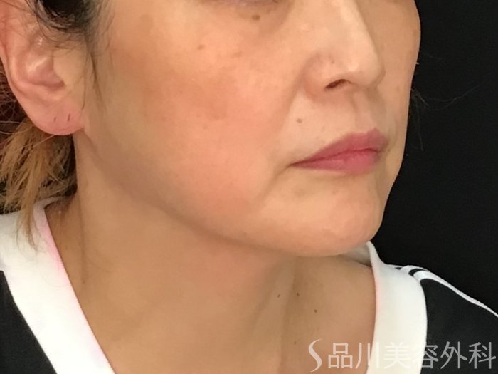 症例NO.69985のBEFORE写真