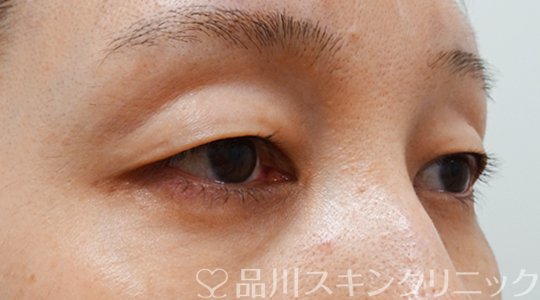 症例NO.70162のBEFORE写真