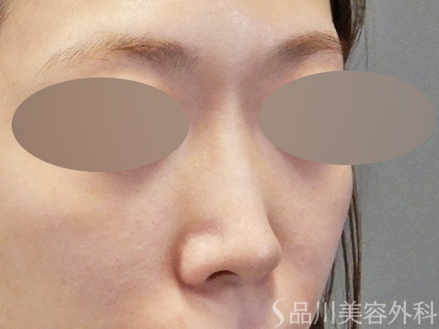 症例NO.64935のBEFORE写真