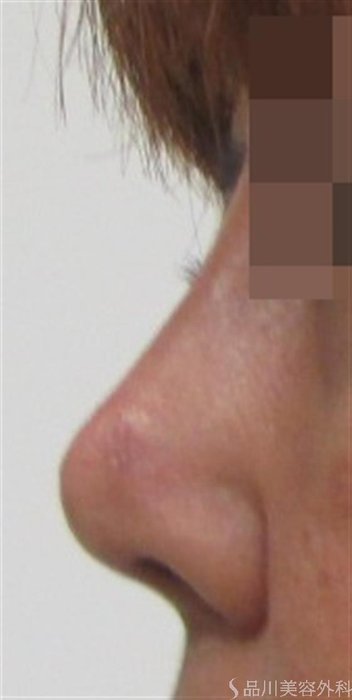 症例NO.22952のAFTER写真