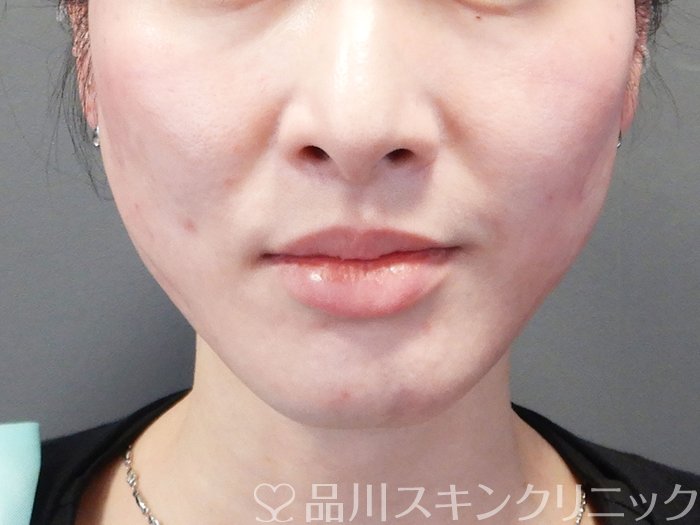 症例NO.72369のAFTER写真