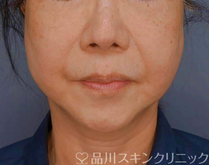 症例NO.74696のAFTER写真