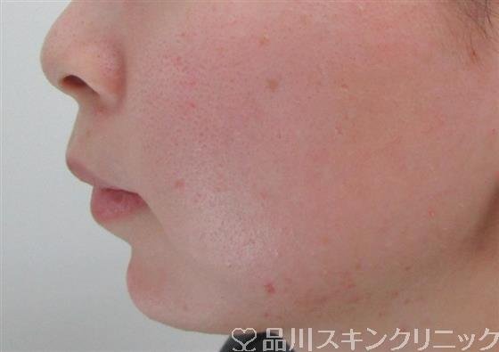 症例NO.34648のAFTER写真
