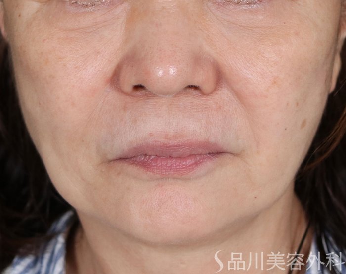 症例NO.71470のBEFORE写真