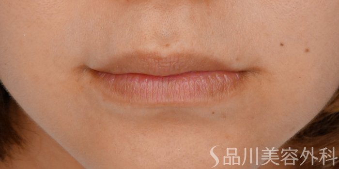 症例NO.71541のBEFORE写真