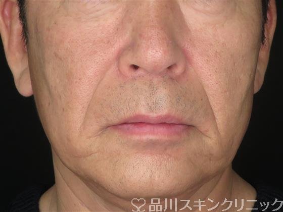 症例NO.54023のBEFORE写真