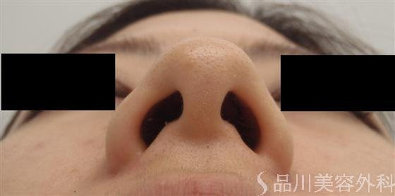 症例NO.14918のBEFORE写真