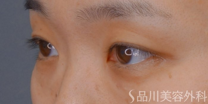 症例NO.74130のBEFORE写真