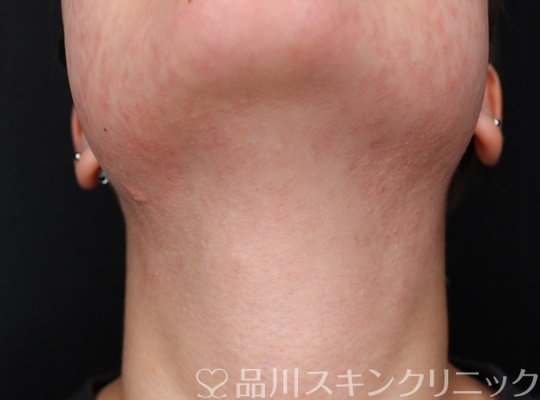 症例NO.72178のAFTER写真
