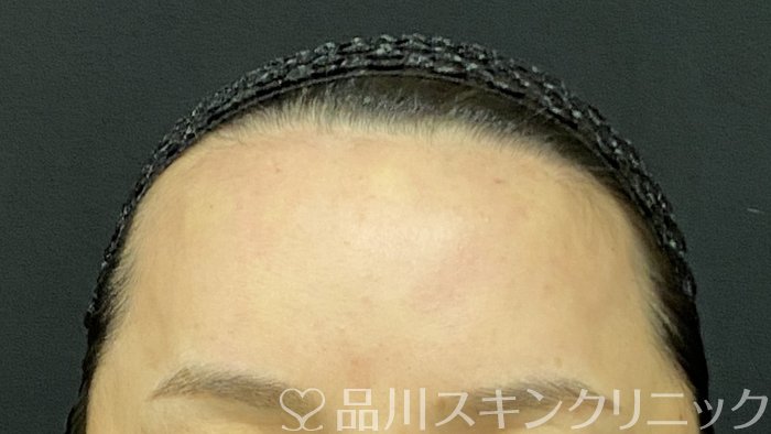 症例NO.74663のAFTER写真