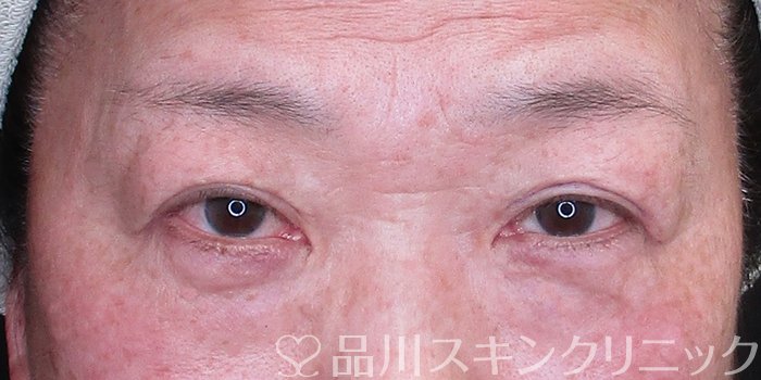 症例NO.74739のBEFORE写真