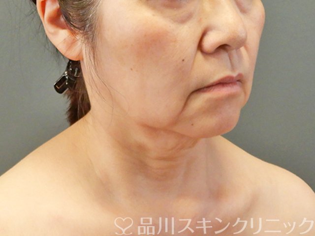 症例NO.67753のBEFORE写真