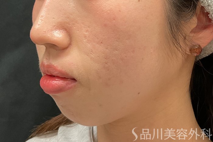 症例NO.73323のBEFORE写真