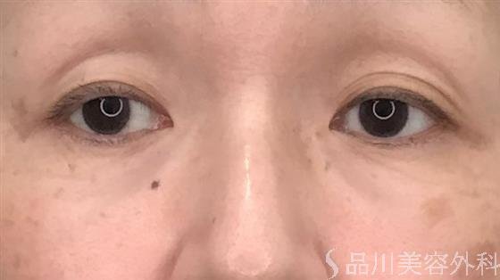 症例NO.56004のBEFORE写真