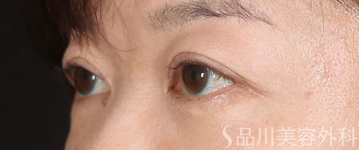 症例NO.73670のAFTER写真