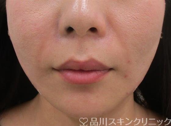 症例NO.40024のAFTER写真
