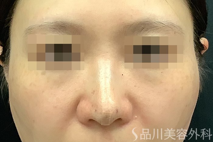 症例NO.71249のAFTER写真