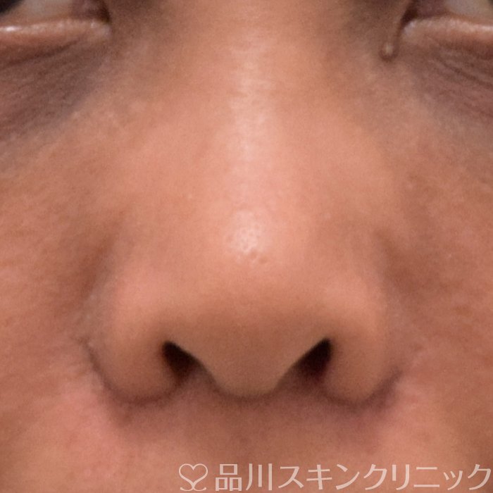 症例NO.70732のAFTER写真