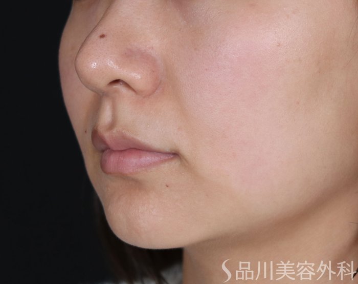 症例NO.71998のBEFORE写真