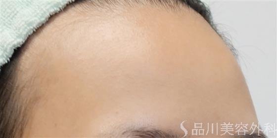症例NO.37213のBEFORE写真