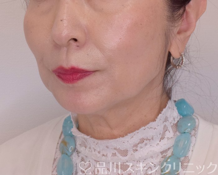 症例NO.70197のAFTER写真