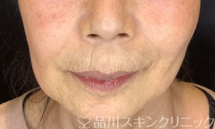 症例NO.72842のBEFORE写真