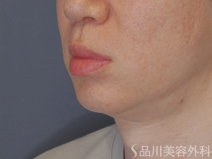 症例NO.70845のBEFORE写真