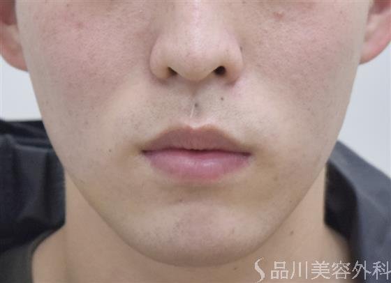 症例NO.47917のAFTER写真
