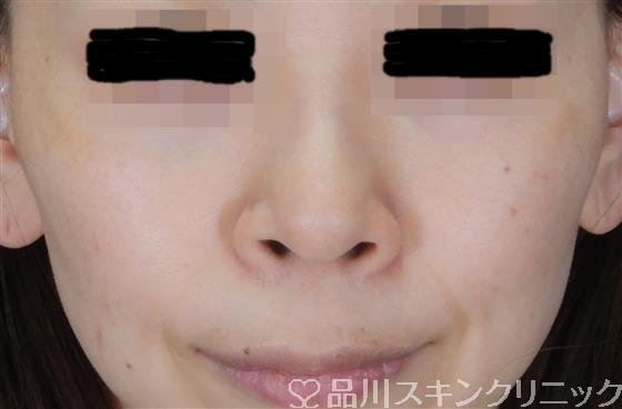 症例NO.60403のBEFORE写真