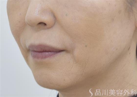 症例NO.46600のBEFORE写真